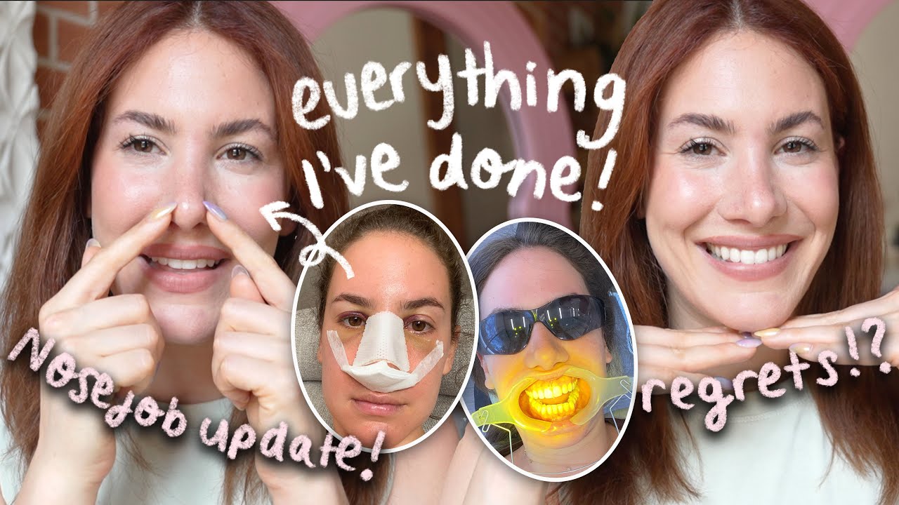 LET'S TALK BEAUTY PROCEDURES 👀 Nose Job Update, Botox Regrets, Invisalign & More!