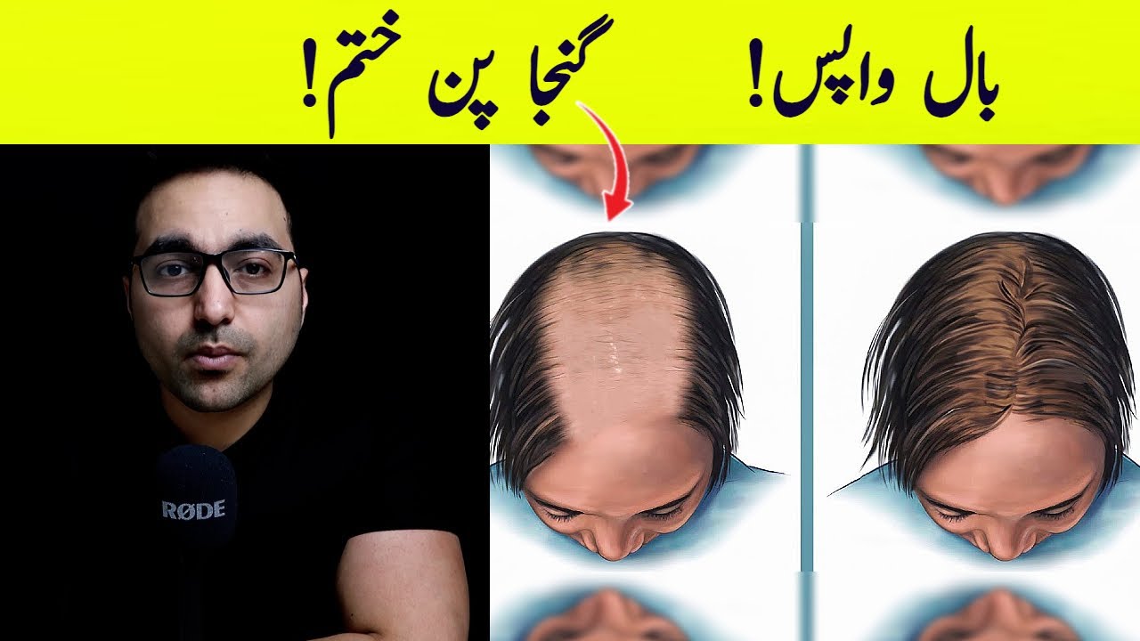 گنجا پن ختم! | Top 3 Foods to Eat To Stop Hair loss