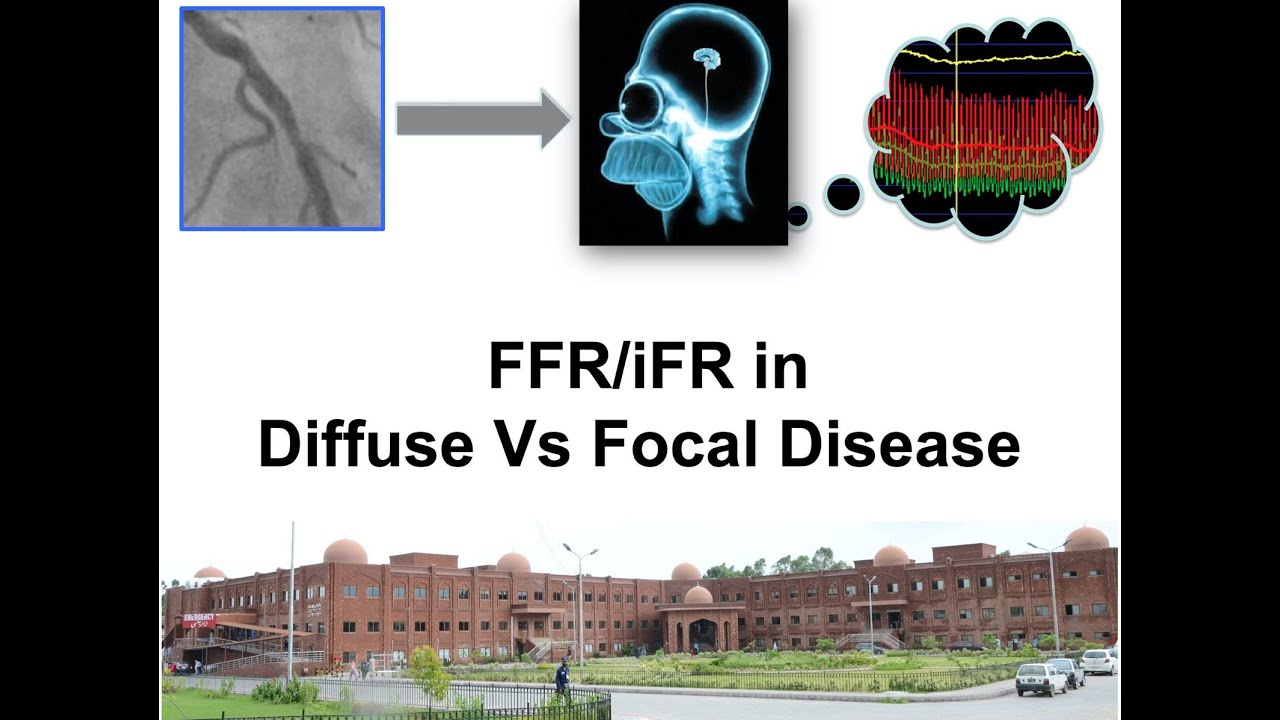 7 Coronary Physiology FFR in Diffuse Vs Focal disease