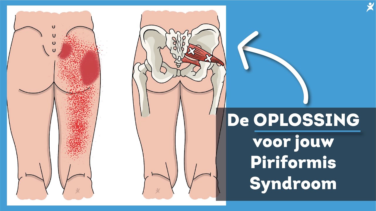'De OPLOSSING voor het Piriformis Syndroom' - Ga niet Rekken!