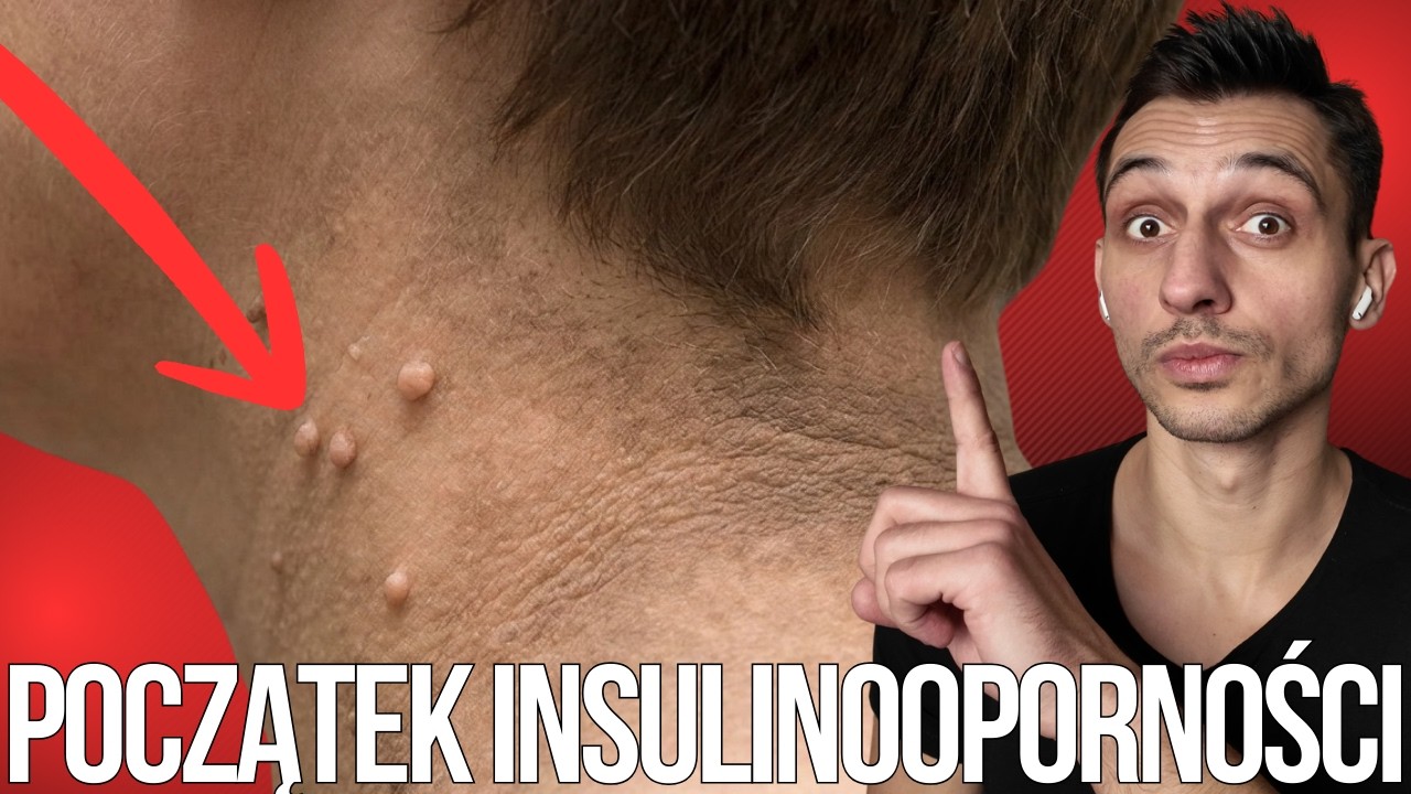 7 NIETYPOWYCH OBJAWÓW INSULINOOPORNOŚĆI, TAKI BRZUCH TO POCZĄTEK!