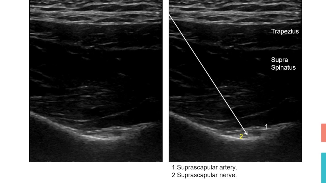 Suprascapular nerve block