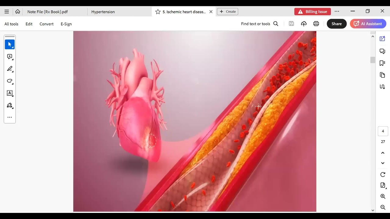 Note File Part 4 Acute Coronary Syndrome (SPLE) د. محمد الهوارى -اختبار الهيئة-واتس 00966555296051