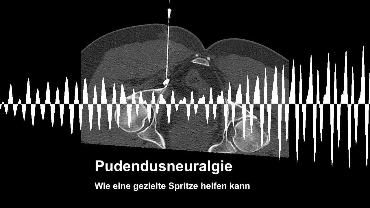 Pudendusneuralgie – Wenn der Nerv im Becken schmerzt