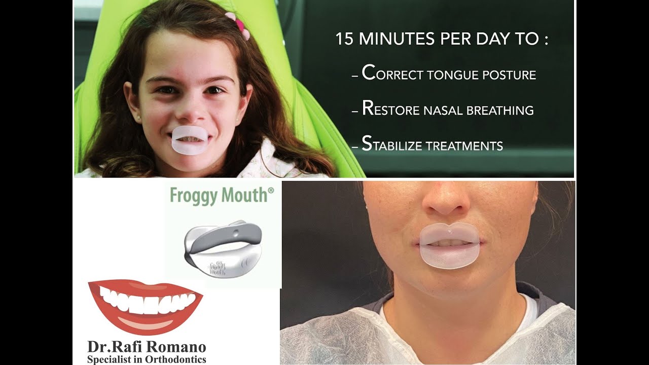 Dr  Rafi Romano  Froggy mouth