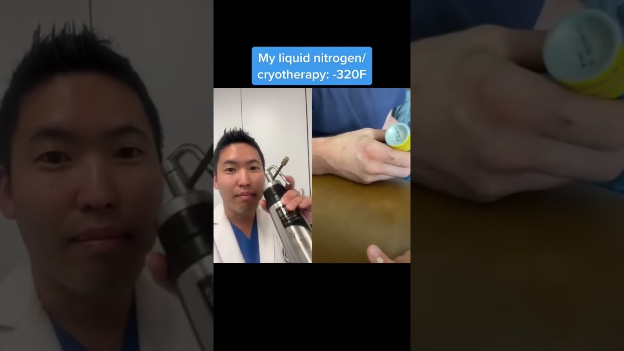 #shorts Dermatologist Reacting to Freeze-Away Wart Treatment