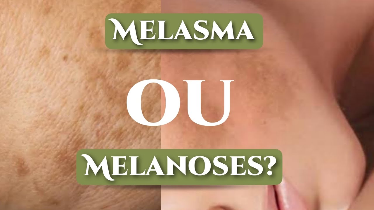 Melasma ou melanoses? Tratar com &aacute;cidos &eacute; a melhor op&ccedil;&atilde;o?