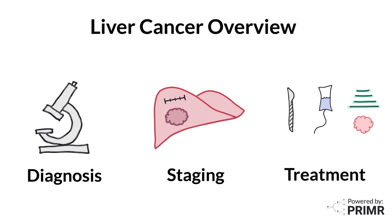 New Liver Cancer Diagnosis - What to Expect?