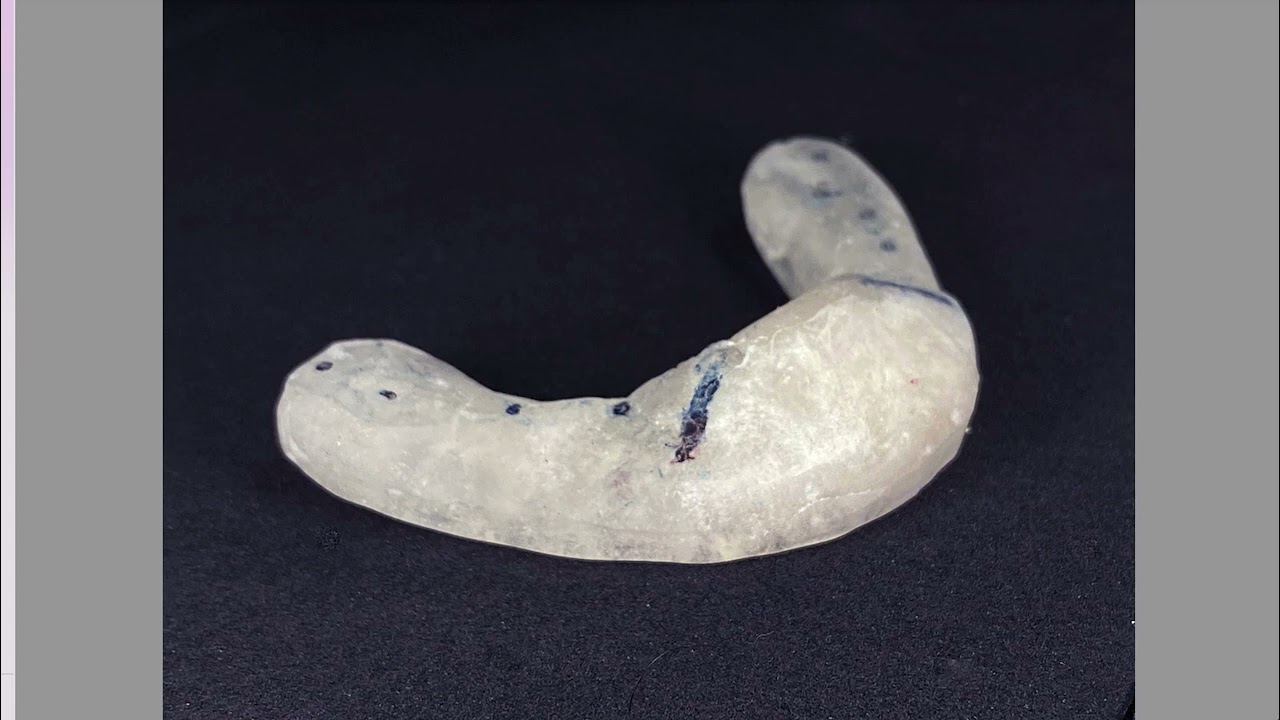 Occlusal splints