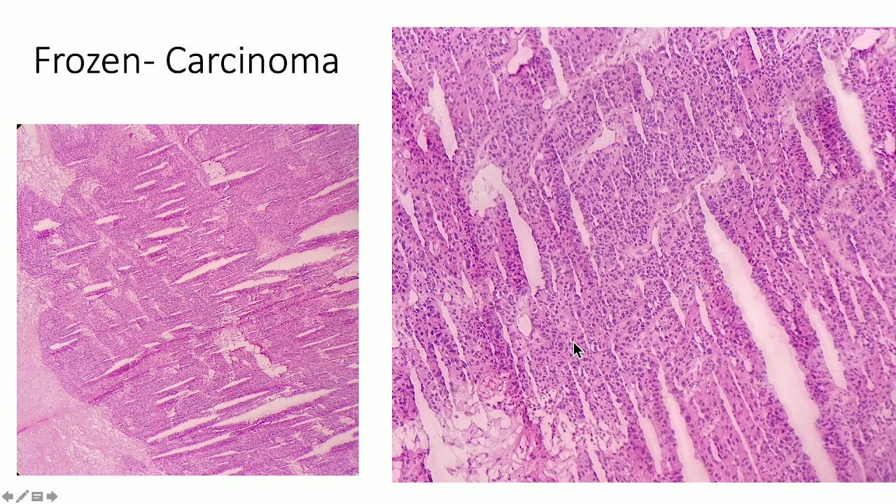 2021 Pathology Review: Gynecologic, Breast and Soft Tissue for the General Pathologist