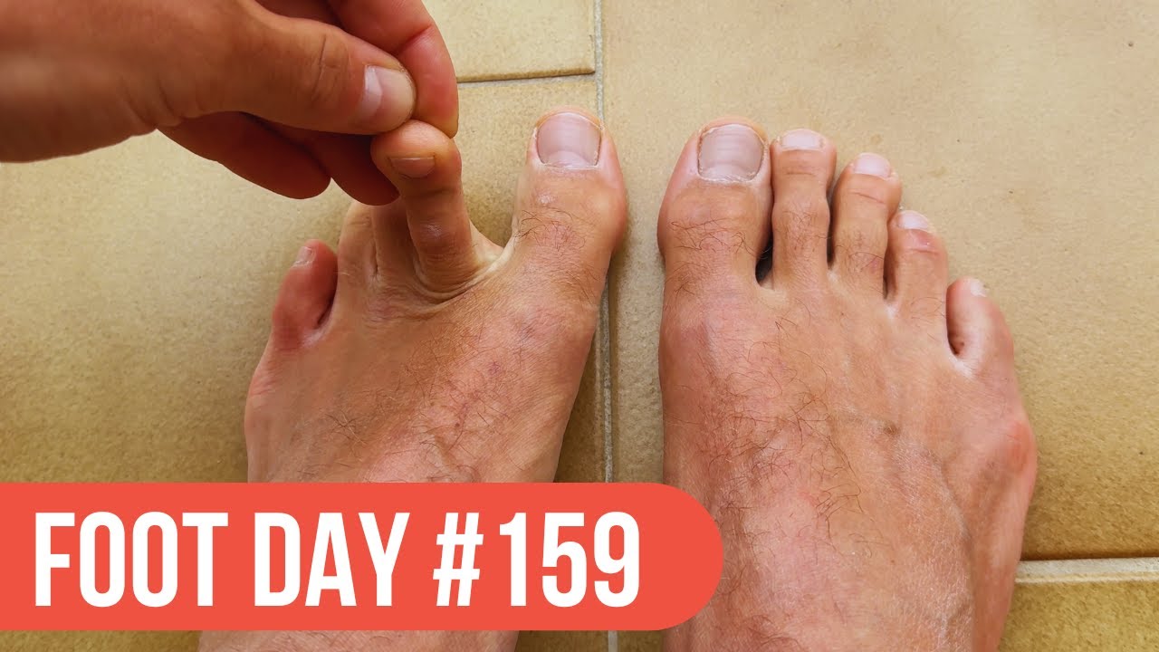 Toe Stretching For Happy Feet – Foot Day 159
