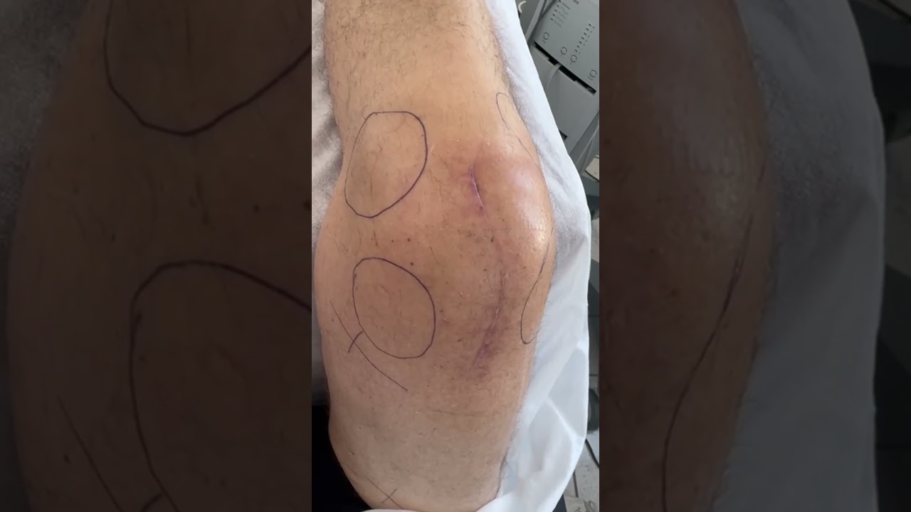 Knie nach OP: Narbe fast weg &ndash; Reha-Experte zeigt was wichtig ist! #reharevolution