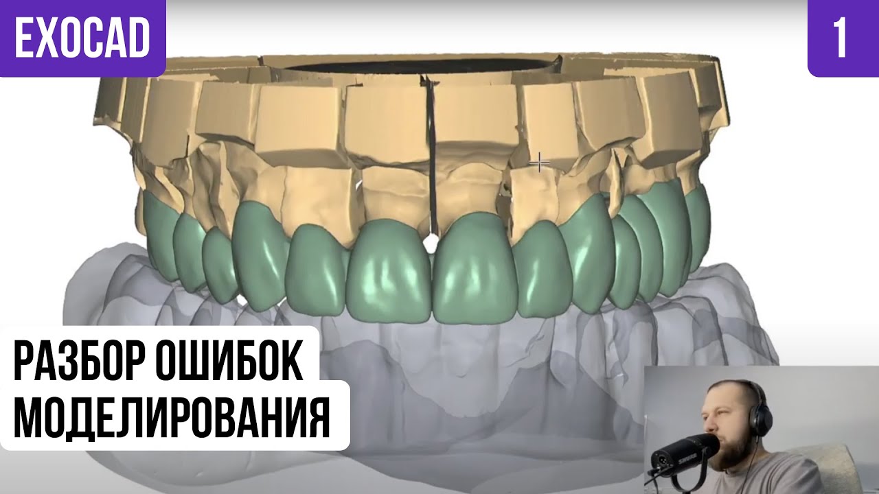 EXOCAD разбор ОШИБОК моделирования реальный клинический случай. Ошибки Exocad Моделирование цифра