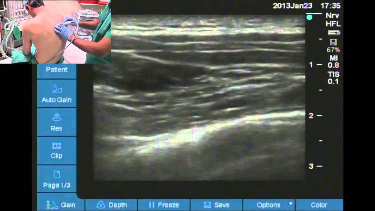 Ultrasound guided thoracic paravertebral space location
