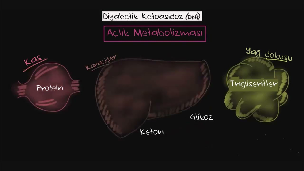 Diyabetin Akut Komplikasyonları: Diyabetik Ketoasidoz (Fen Bilimleri) (Sağlık Bilgisi ve Tıp)