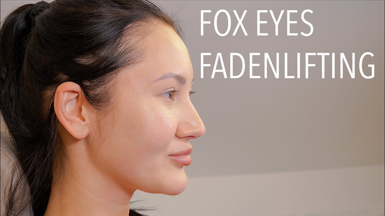 Fox Eyes - Fadenlifting