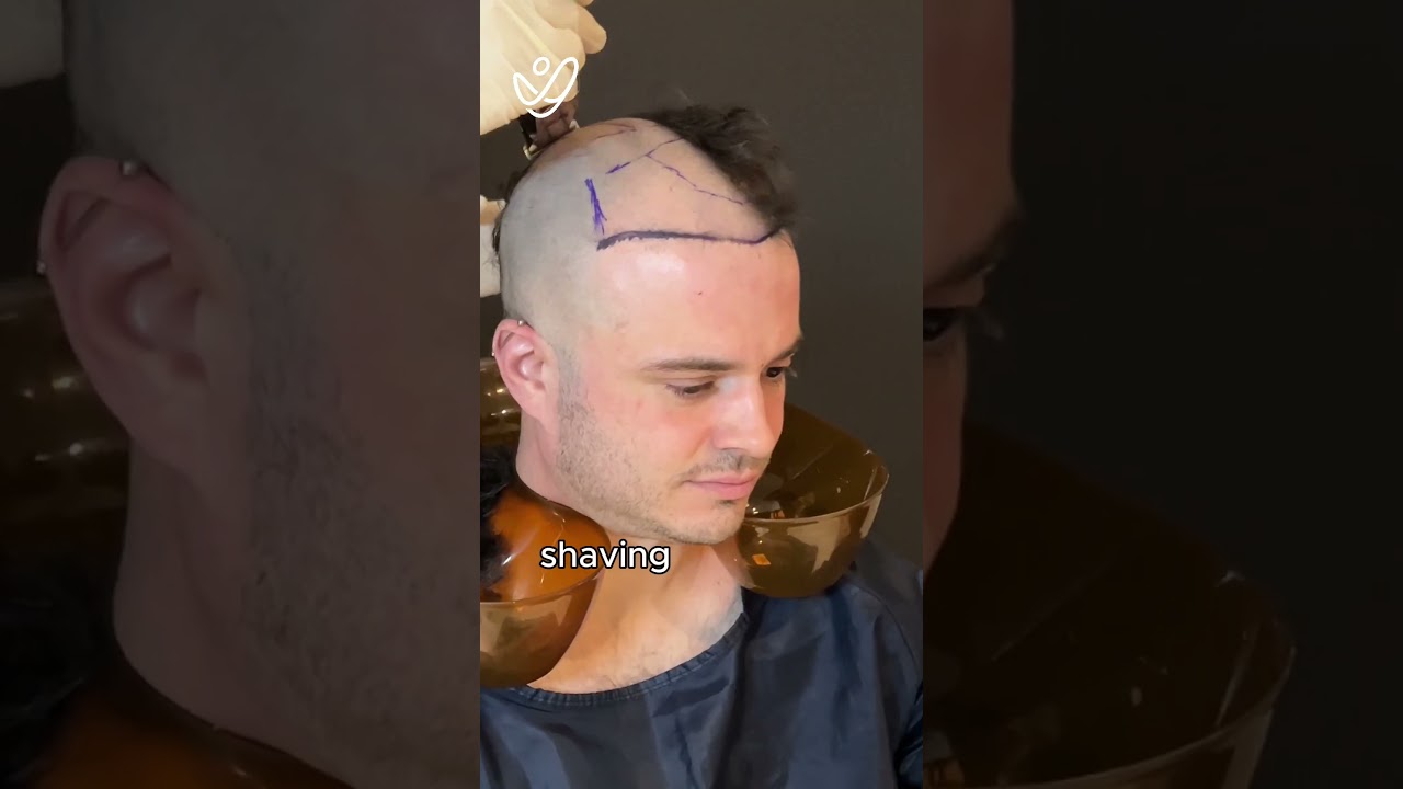 My Hair Transplant Journey From Start to 1 Month!