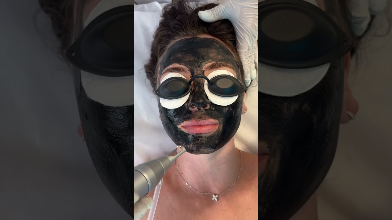 Love is&hellip; 💙 The glow after a Carbon Laser Peel! #carbonpeel #skincare #zemits #beauty