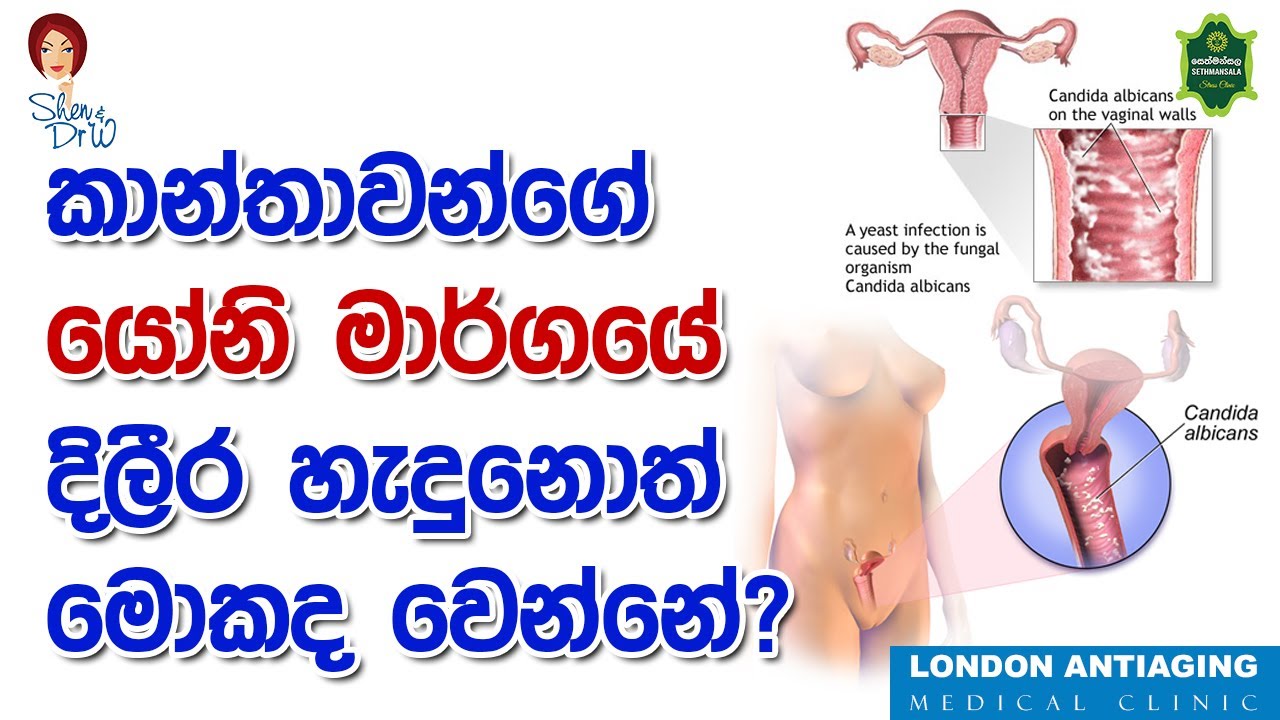 කාන්තාවන්ගේ යෝනි මාර්ගයේ දිලීර හැදුනොත් මොකද වෙන්නේ?