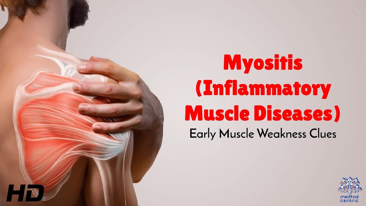 Myositis (Inflammatory Muscle Diseases): Early Muscle Weakness Clues