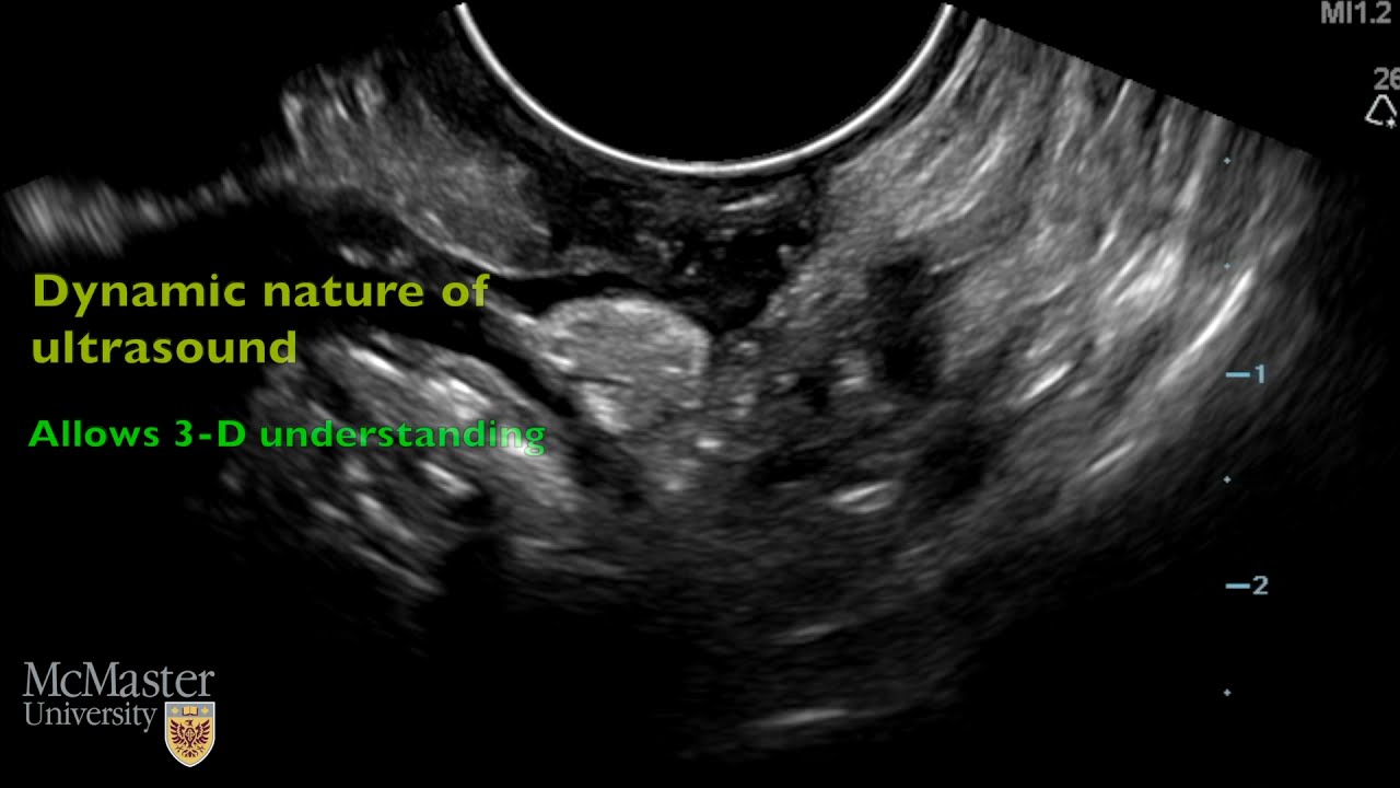 Uterosacral ligaments on transvaginal ultrasound: a video introduction and focus on endometriosis