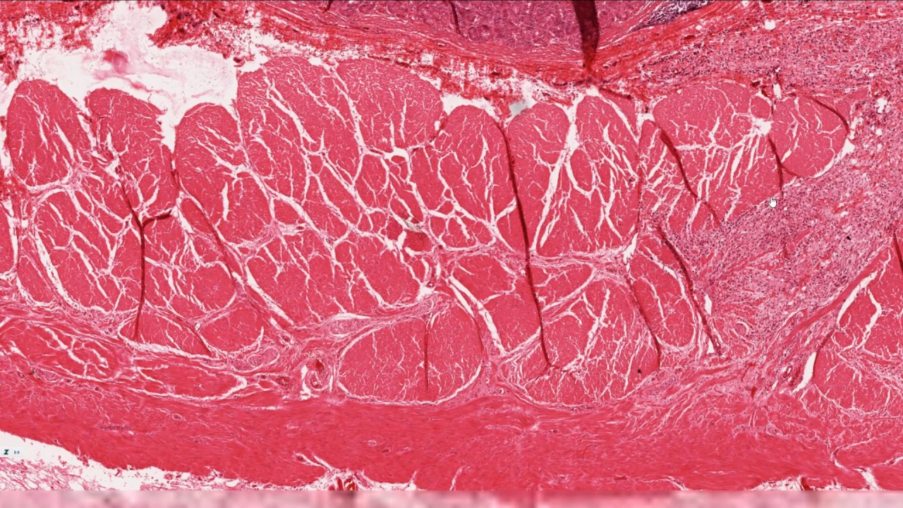 Histopatoloji - Taşlı Yüzük Hücreli Karsinom