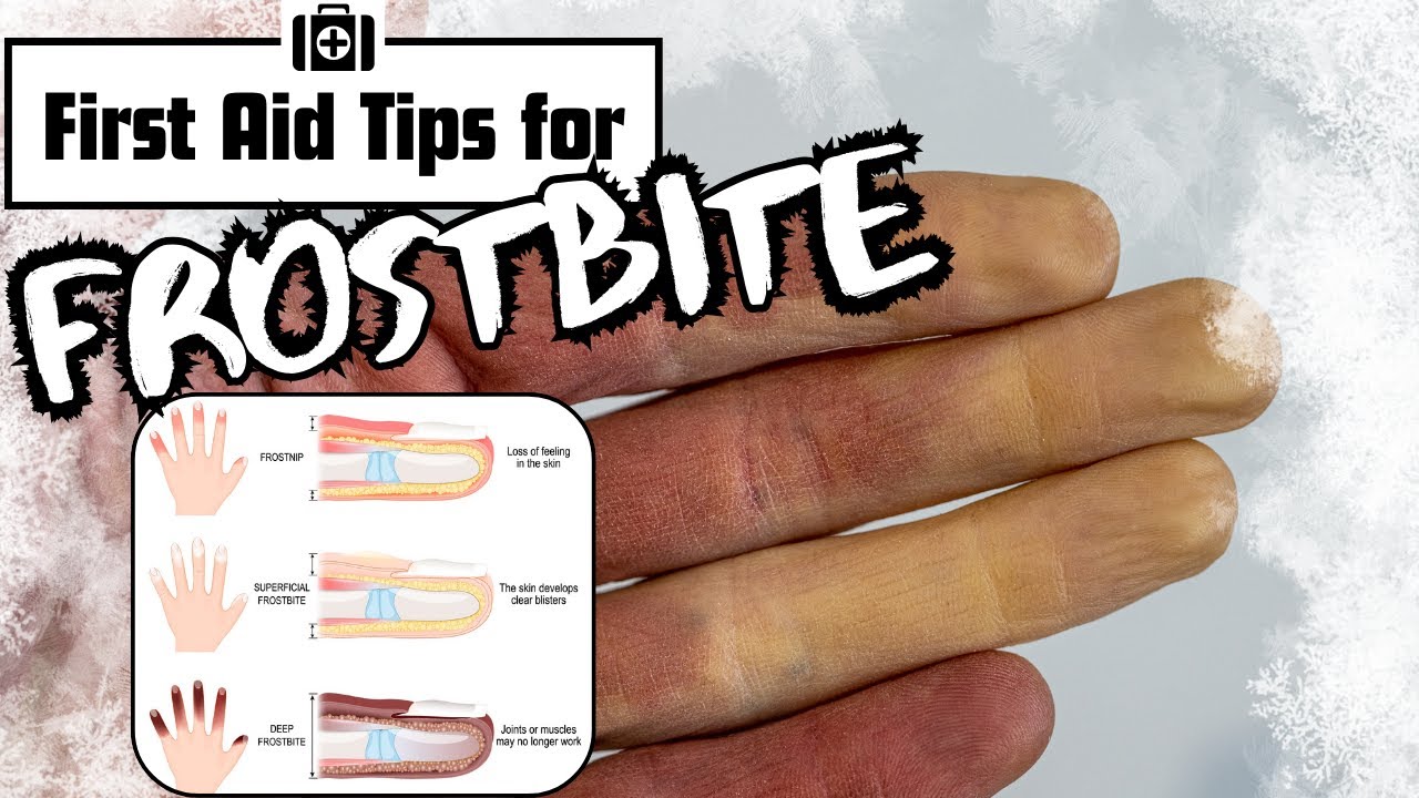 Frostbite - Symptoms and First Aid