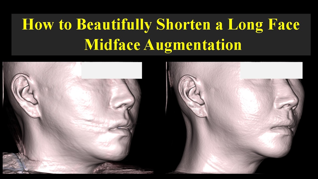 How to Beautifully Shorten a Long Face with Midface Augmentation