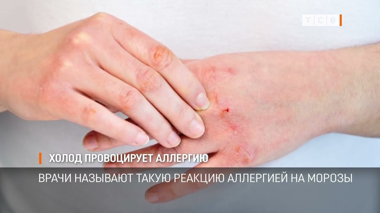 Холод провоцирует аллергию