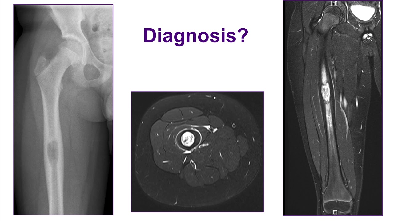 Benign Bone Tumors - ABOS Orthopedic Surgery Board Exam Review