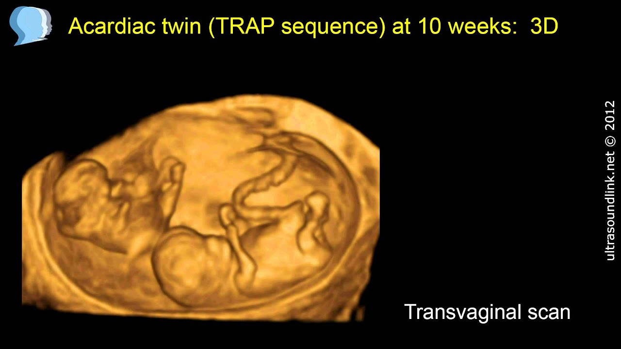 Acardiac twin (TRAP sequence) at 10 weeks