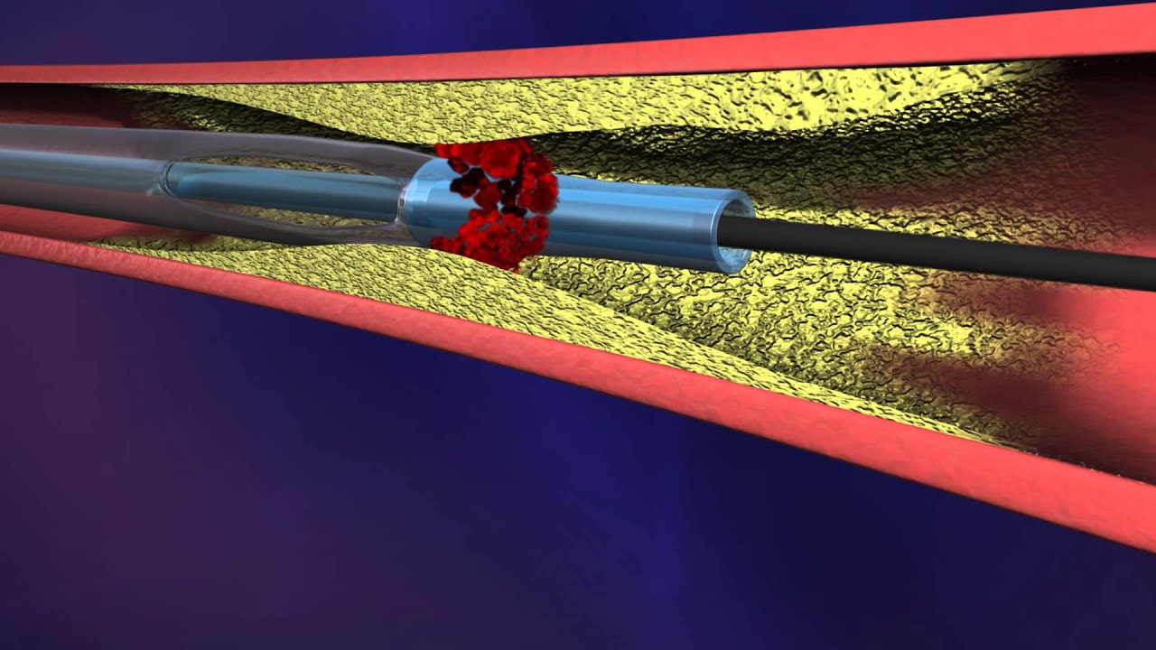 ASPIRE Mechanical Thrombectomy System