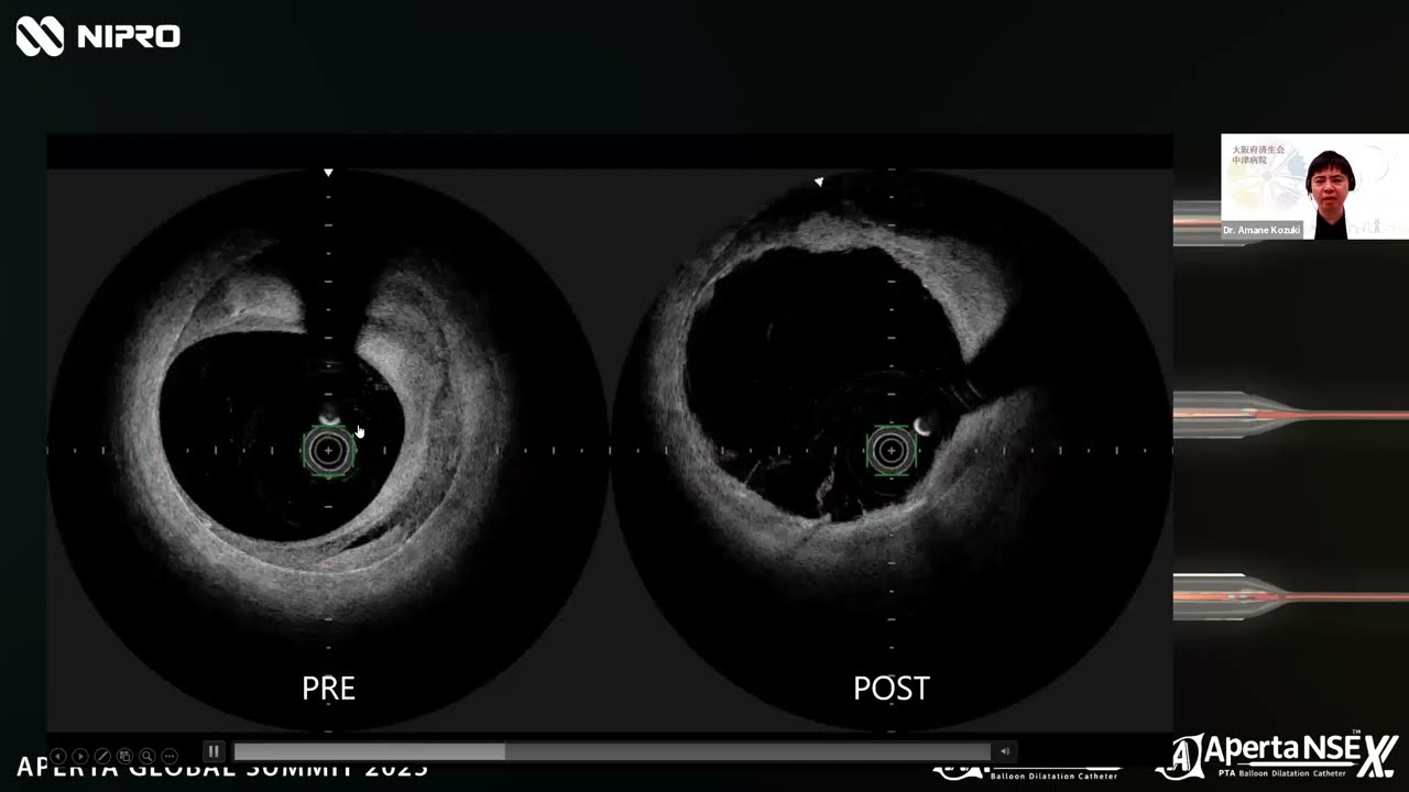 Aperta Global Summit 2026: Comparing U.S. and Japanese Approaches to Femoropopliteal Lesions