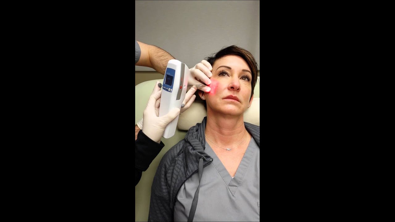 Dr. Seiler injects Juvederm VOLUMA in the Cheeks
