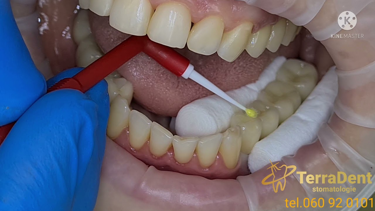 Stomatologie Chisinau,Botanica-TerraDent!Coroane dentare din Ceramica cu suport ZIRCONIU- PE IMPLANT