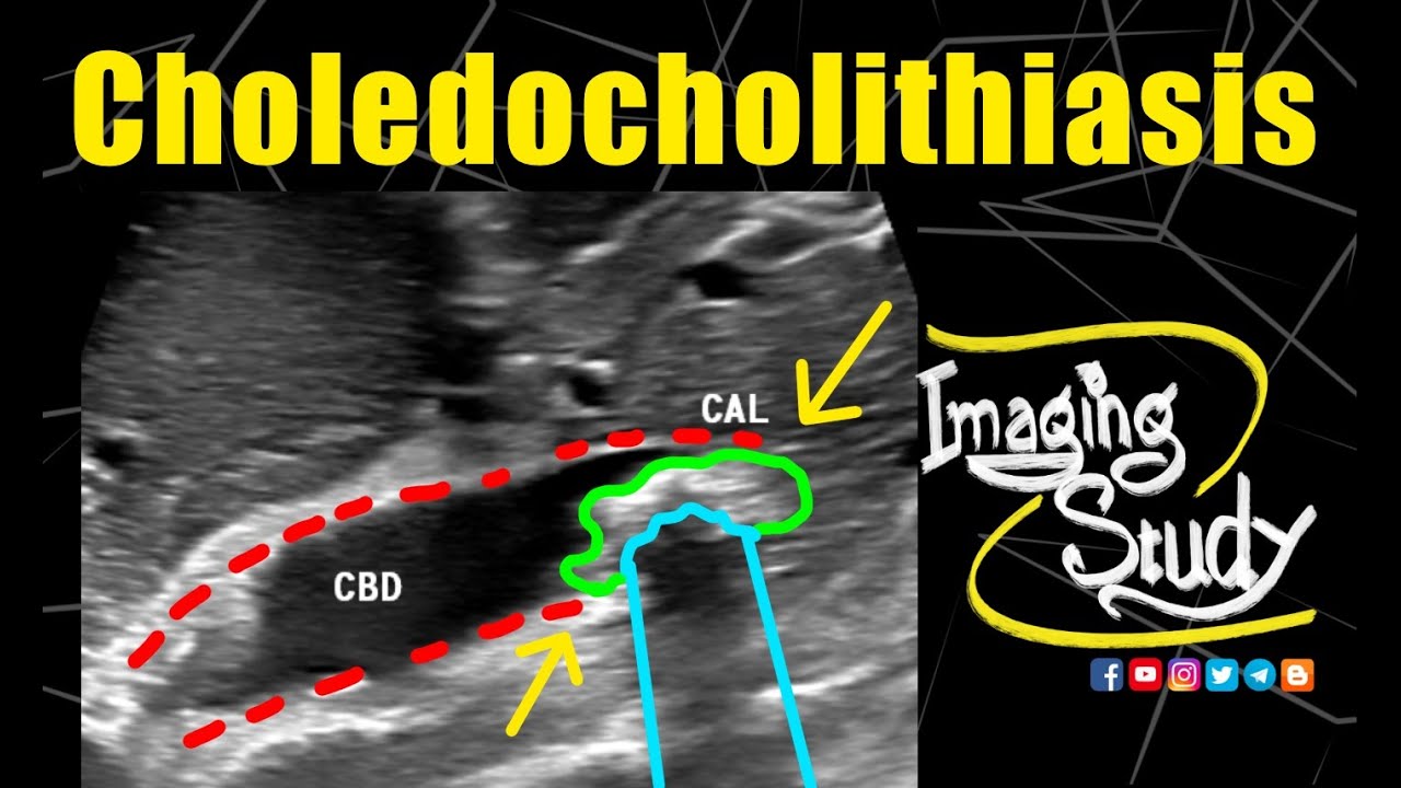 Choledocholithiasis || Common Bile Duct Calculus || Ultrasound || Case 264