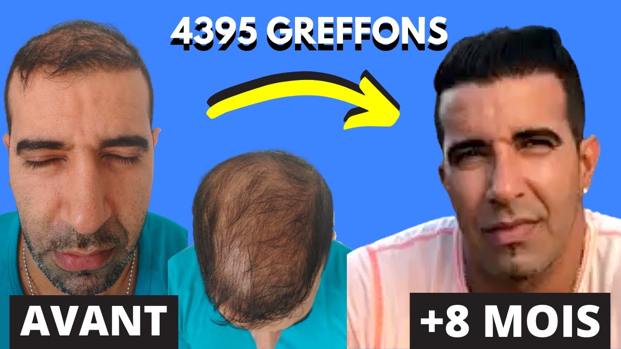 Greffe de Cheveux : Le Résultat 