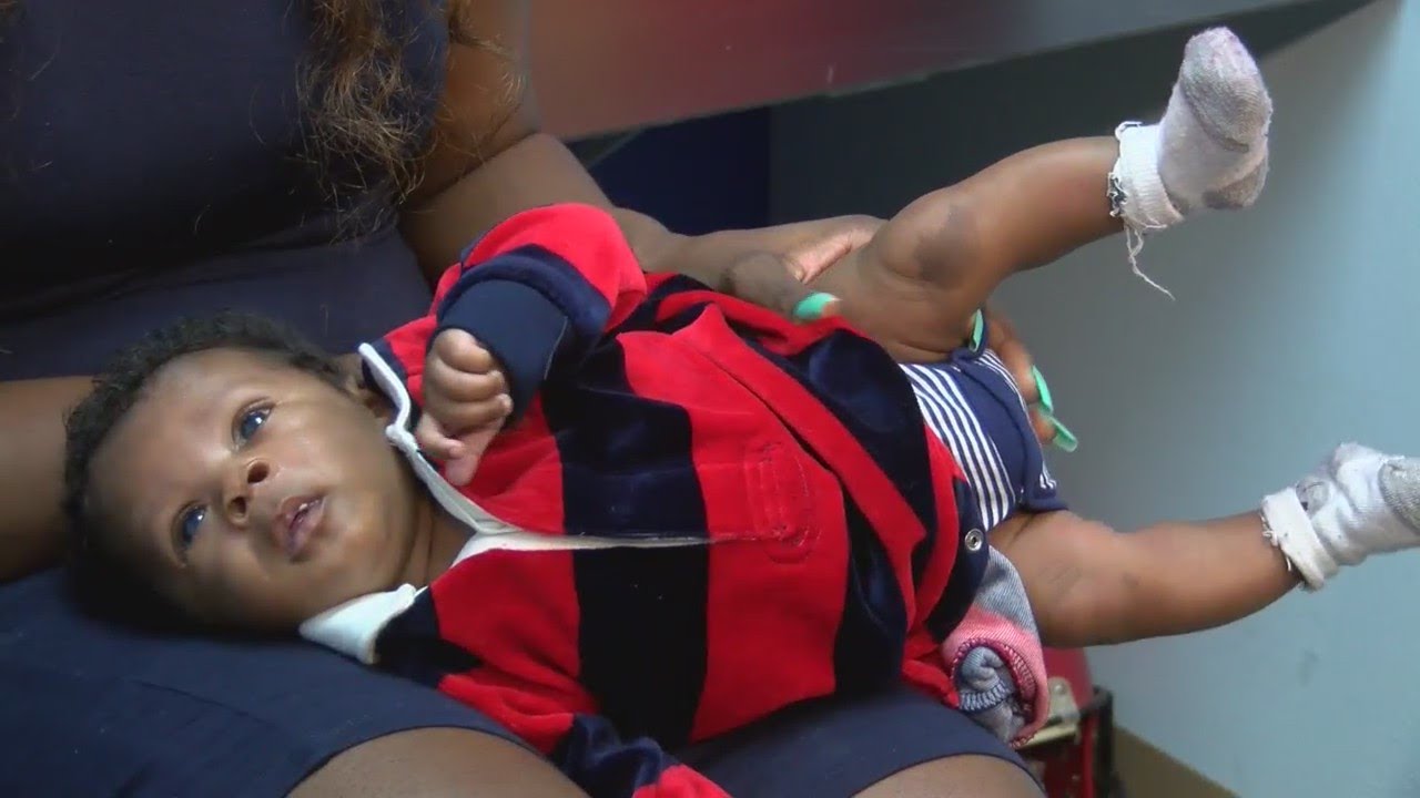 Baby absorbs twin, carries birthmark resembling his sister
