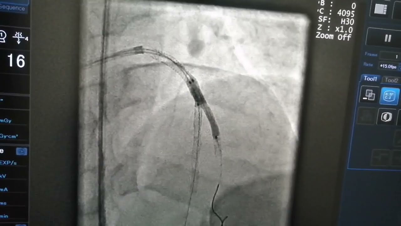 Provisional bifurcation strategy ||Dissection of good size diagonal branch || Tap technique