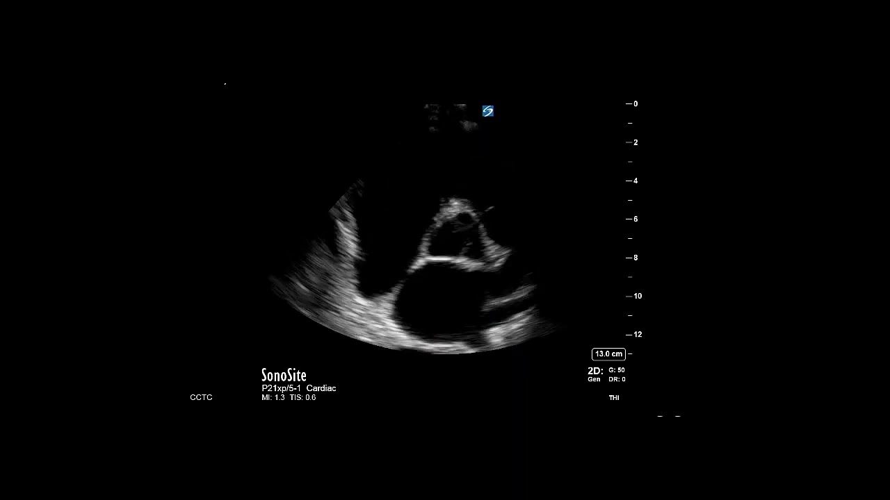 How to...Measure Mean Pulmonary Artery Pressure From Tricuspid Regurgitation