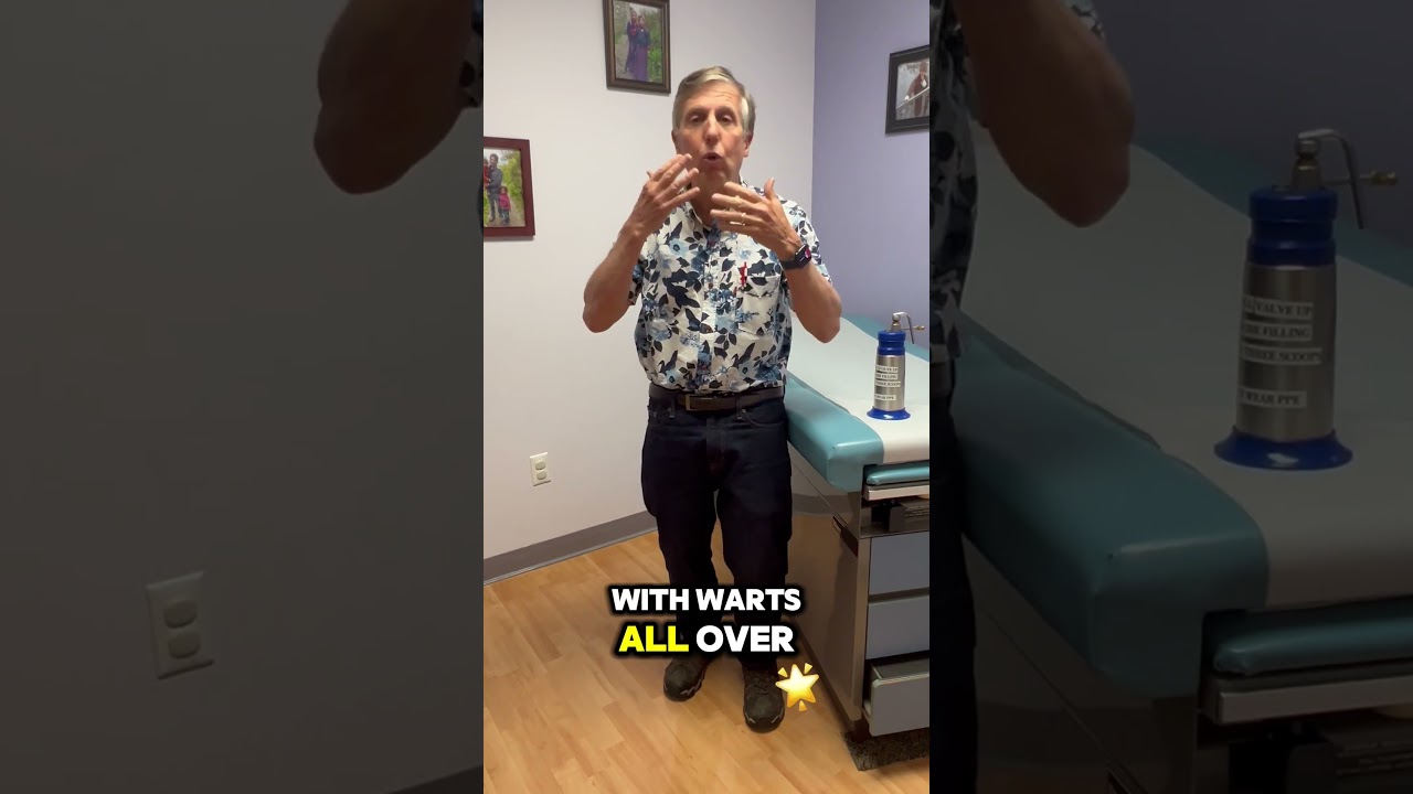 Removing Warts Without Using Liquid Nitrogen