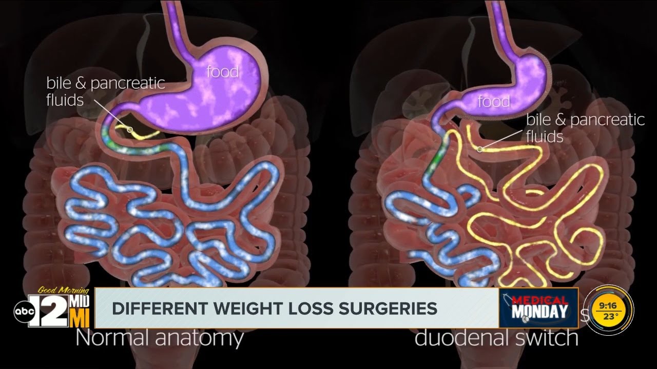 Hurley bariatric surgeon discusses weight loss options