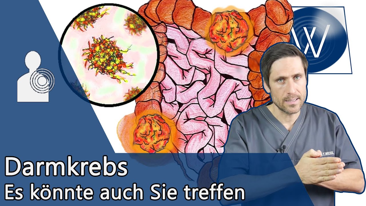 Darmkrebs: Was wir dagegen tun können & worauf wir achten müssen – Ursachen, Symptome & Therapie
