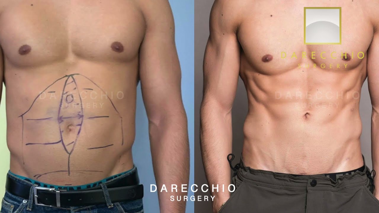 Diastasi dei muscoli retti in giovane sportivo |  Dr. Darecchio