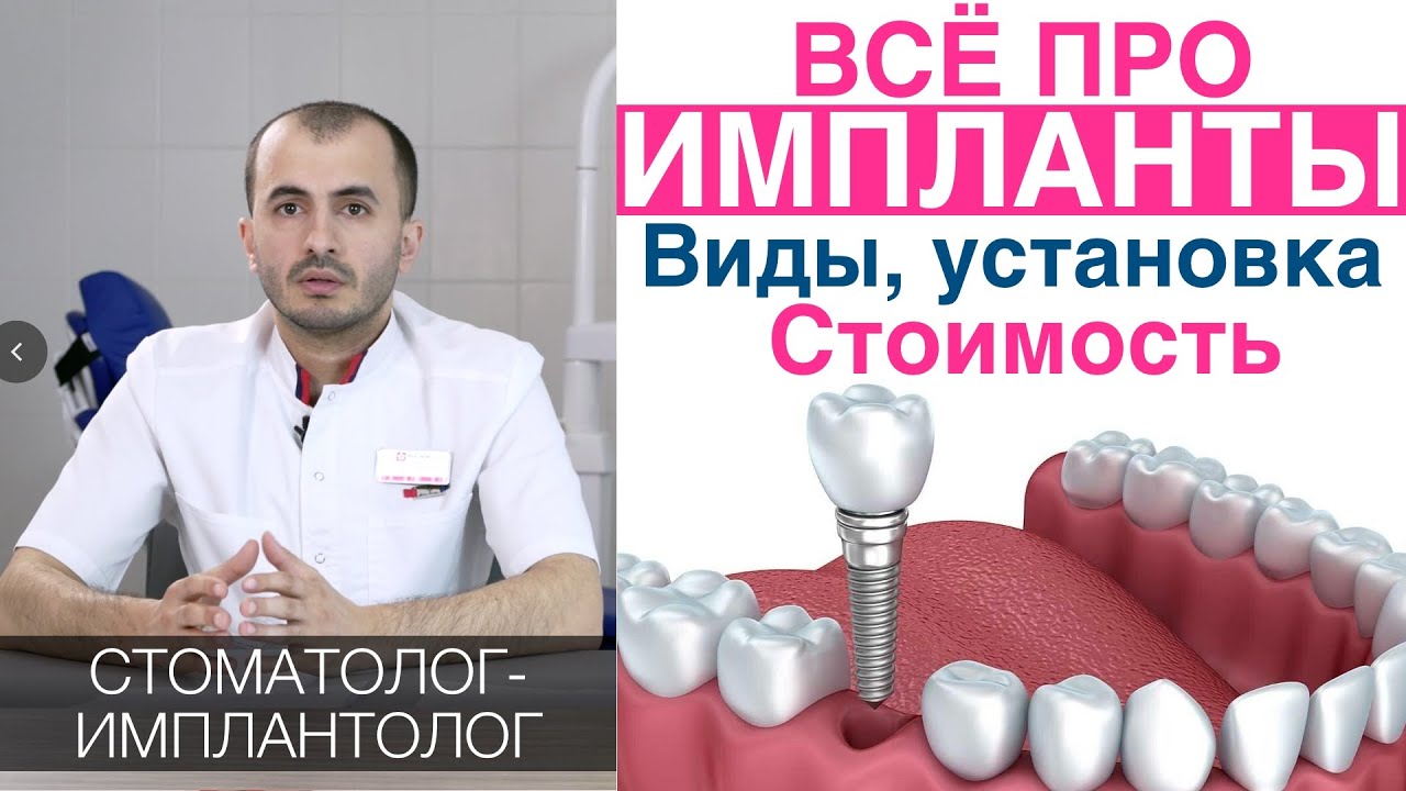 Зубные импланты - как выбирать, цена, установка имплантов зубов, гарантия. Имплантация зубов.