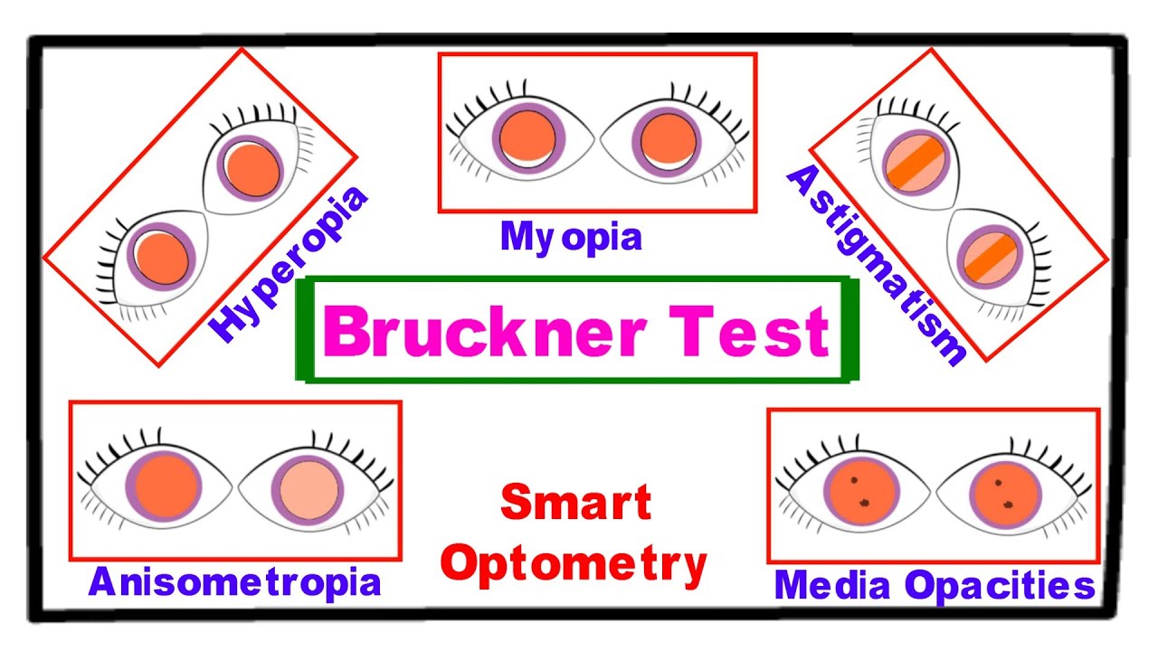 Bruckner Test - A Complete Tutorial