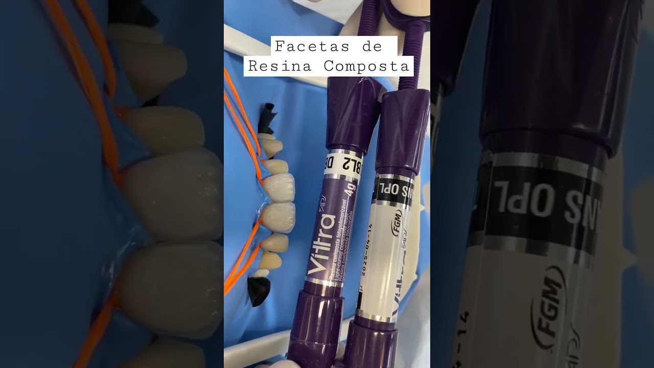 Facetas de resina composta direta! #dentes #dentistas #odontologia