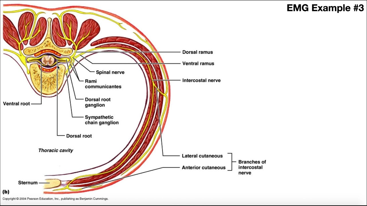 Diagnosing Nerve Damage with EMG [Example 3] | UE Radiculopathy