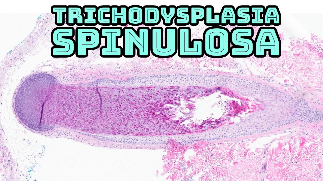 Trichodysplasia Spinulosa (hair follicle virus infection after transplant immunosuppression)