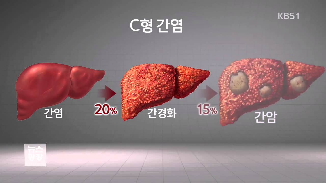 간암 원인 2번째 &lsquo;C형 간염&rsquo; 검진율 10% 불과